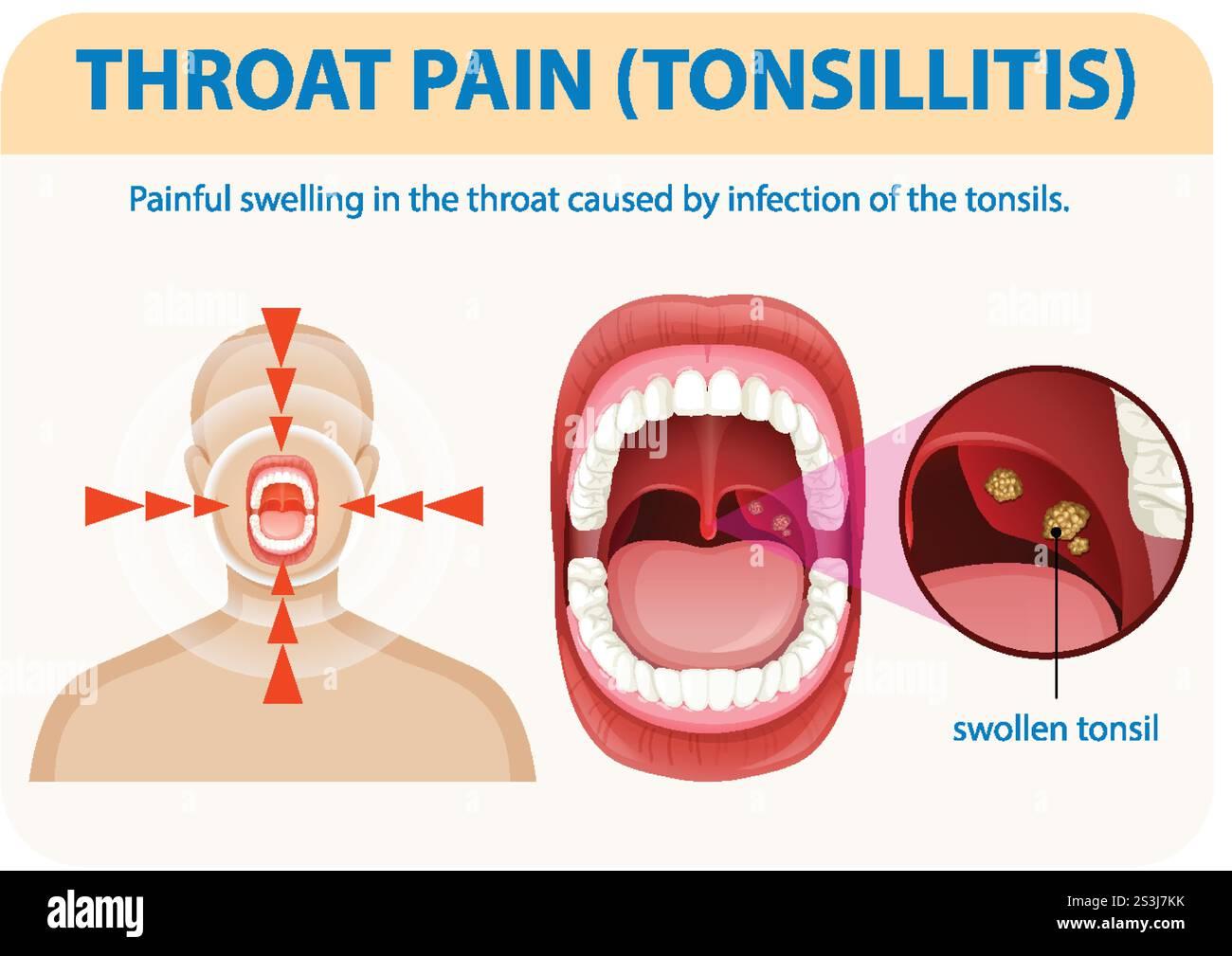 Tonsilitis & Throat Pain
