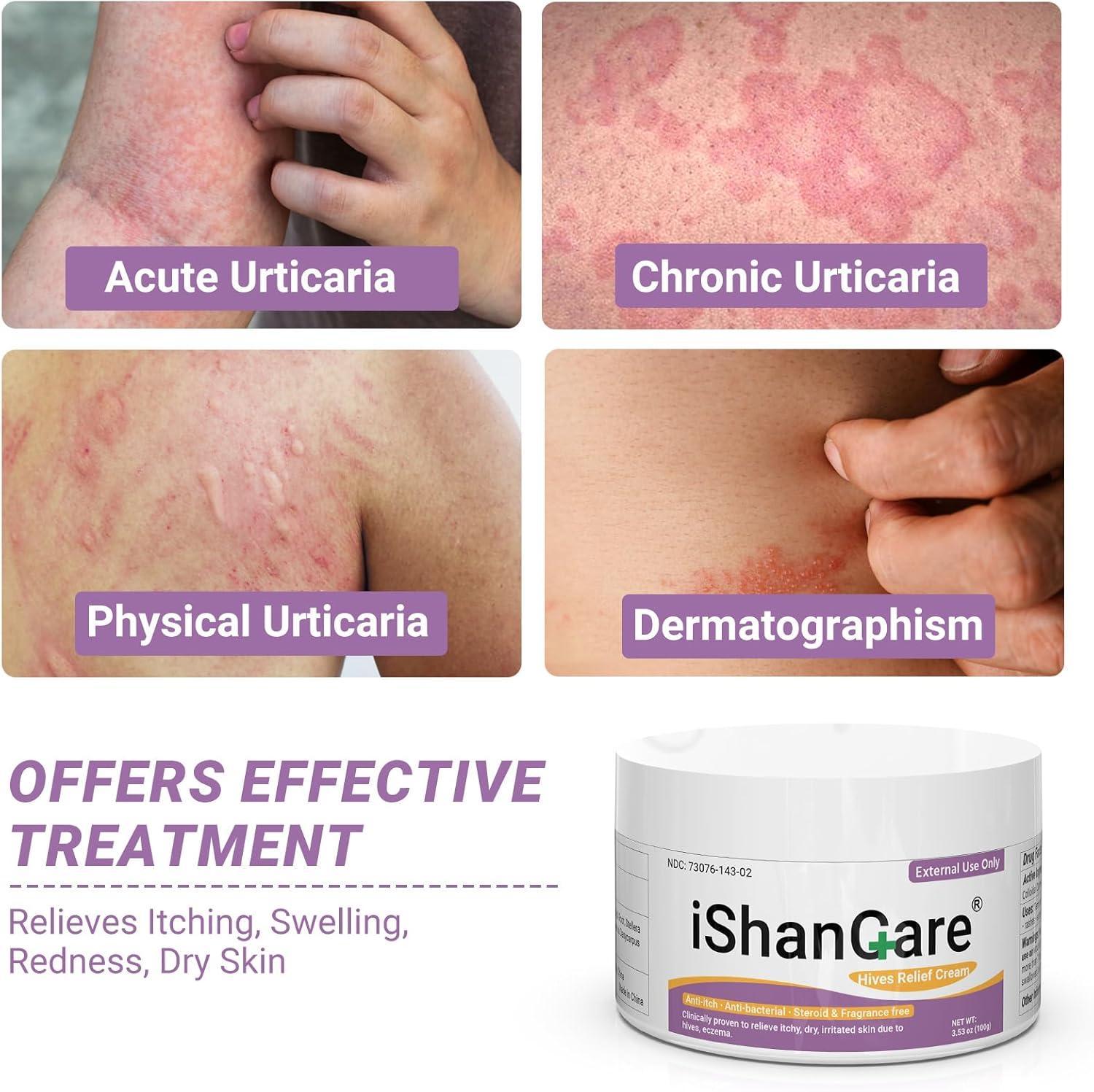 Rash/Itch/Urticaria/Hives
