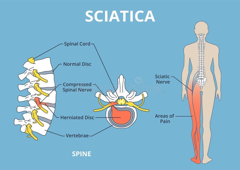 Sciatica